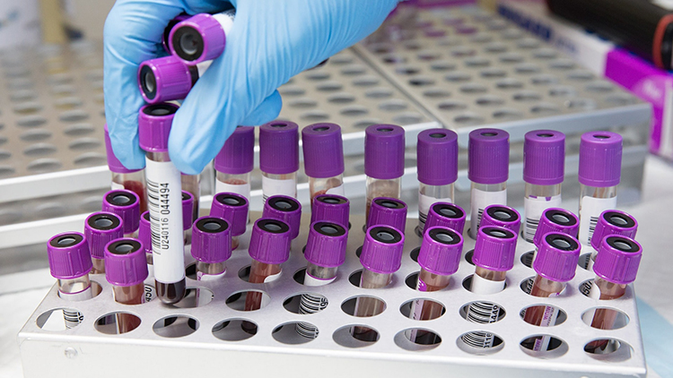Understanding Thyroglobulin Antibodies (TgAb)